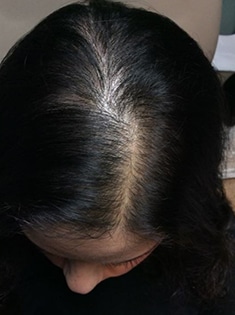 after Image of Hair Restoration Leon Valley TX