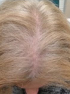 Before Image of Hair Restoration Procedure San Antonio TX
