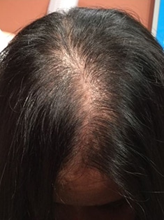 Before Image of Hair Restoration Leon Valley TX