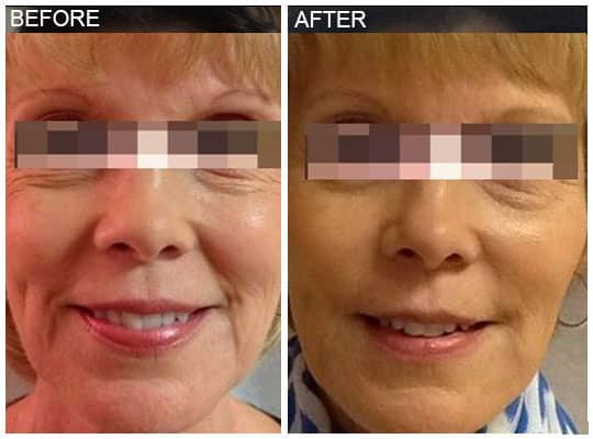 Before & after Image of Voluma San Antonio