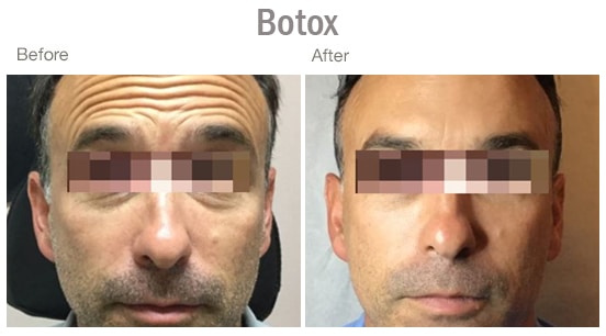 Before & after Image of Botox San Antonio TX