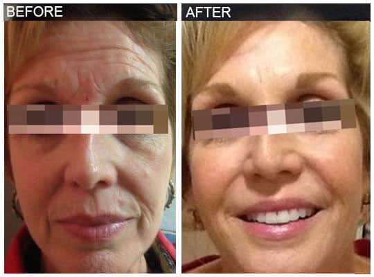 Before & after Image of Voluma Leon Valley TX