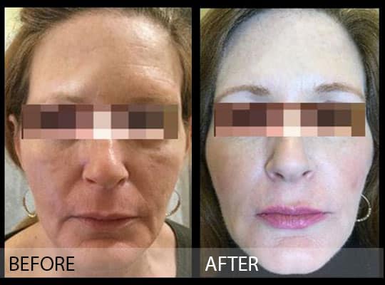 Before & after Image of Voluma treatment San Antonio TX