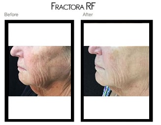 Before & after Image of Fractora RF San Antonio TX