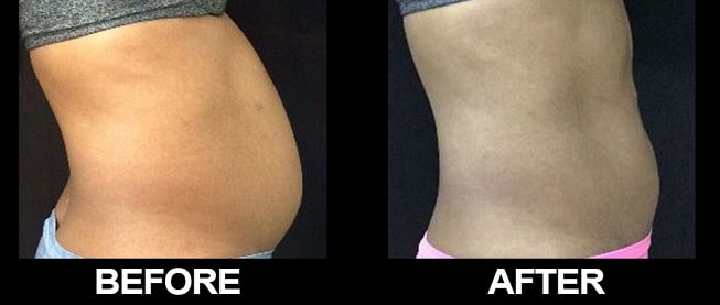 side view of patient’s stomach before and after sculpsure body contouring, flatter after procedure