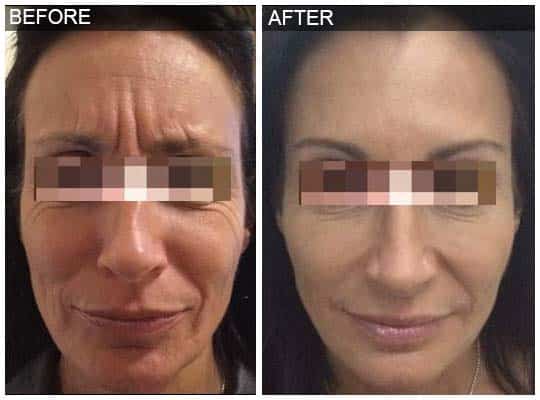 Before & after Image of Voluma treatment Leon Valley TX
