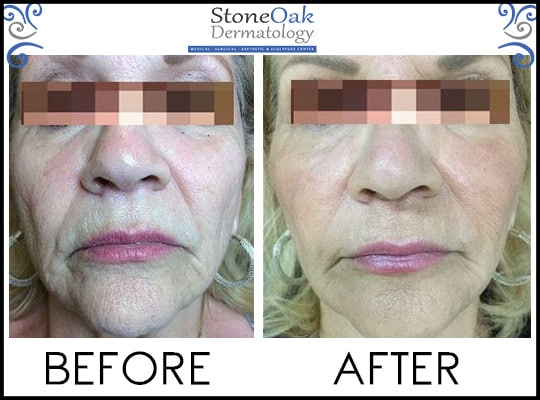 Before & after Image of Volumalift™ San Antonio TX