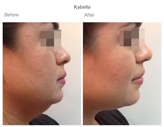 Before & after Image of Kybella San Antonio TX