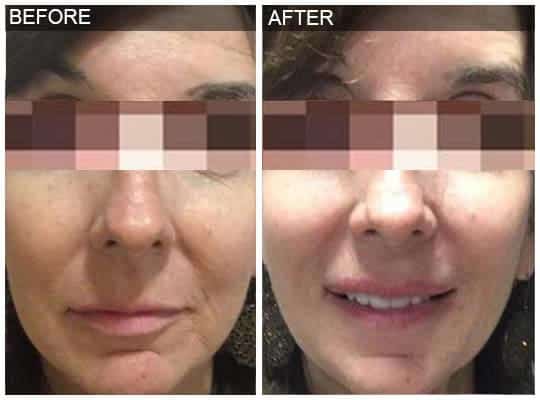 Before & after Image of Voluma treatment San Antonio