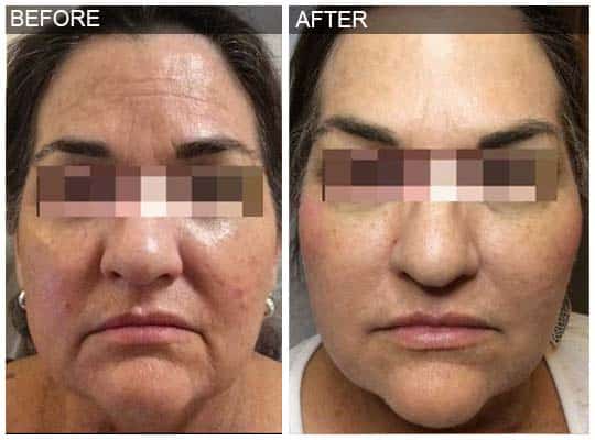 Before & after Image of Voluma San Antonio TX