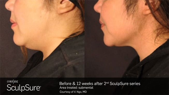 young woman’s side profile before and after sculpsure non-surgical contouring treatment showing less chin fat after procedure