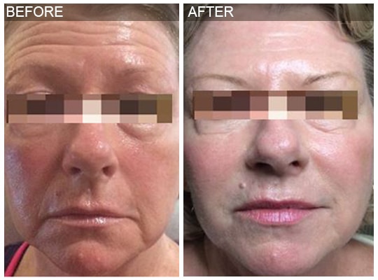 Before & after Image of Volumalift™ Leon Valley TX