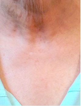 after Image of Photofacial IPL Treatment Leon Valley TX
