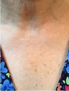 Before Image of Photofacial IPL Treatment Leon Valley TX