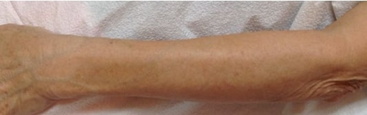after Image of IPL Treatment Leon Valley TX