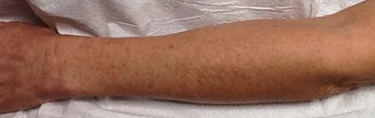 Before Image of IPL Treatment Leon Valley TX