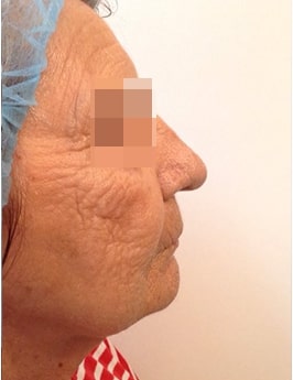 after Image of Photofacial Leon Valley TX