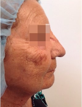 Before Image of Photofacial Leon Valley TX