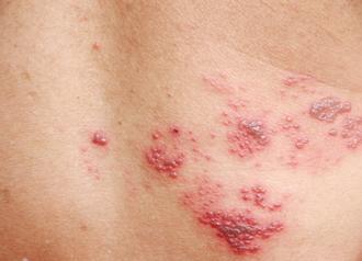 finding the right treatment for shingles 6228a6fd88f8b