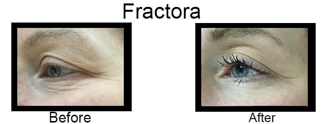 Before & after Image of Fractora RF Leon Valley TX