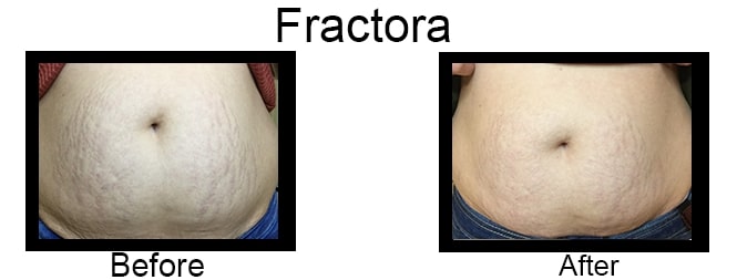 Before & after Image of Fractora Leon Valley TX