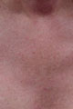 after Image of Photofacial Treatment Leon Valley TX