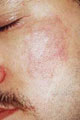 after Image of Intense Pulse Light Photorejuvenation Leon Valley TX