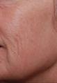 after Image of Photofacial Treatment San Antonio TX