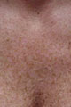 Before Image of Photofacial Treatment Leon Valley TX