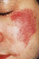 Before Image of Intense Pulse Light Photorejuvenation Leon Valley TX