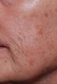 Before Image of Photofacial Treatment San Antonio TX