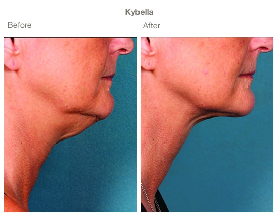Before & after Image of Double Chin Treatment San Antonio TX