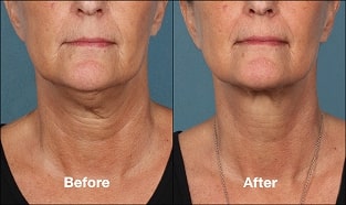 Before & after Image of Kybella Leon Valley TX