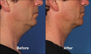 Before & after Image of Double Chin Treatment Leon Valley TX