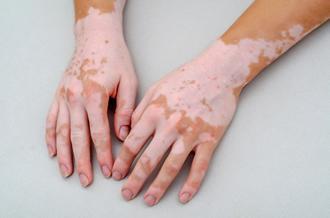 treating your vitiligo 6228a6b9c432d