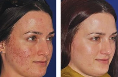 Before & after Image of Microneedling San Antonio TX