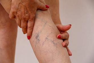 what are spider veins 6228a69e7544b