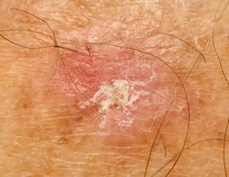 what is actinic keratosis 6228a6e94d89a