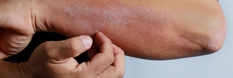 banner eczema