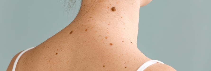 mole removal San Antonio TX