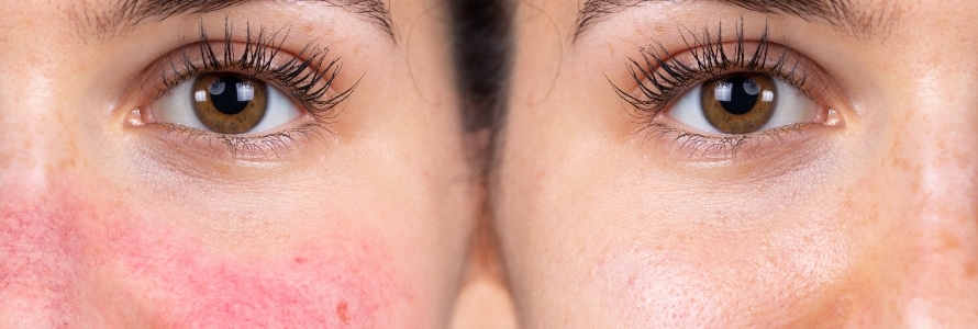 banner rosacea