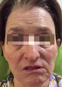 Before Image: Botox, Fillers, Fractora, Chemical Peels, and SkinMedica - front