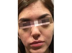 After Image: Accutane - front