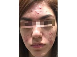 Before Image: Accutane - front