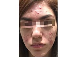 Accutane