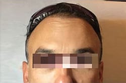 After Image: Botox - front