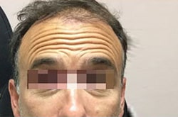 Before Image: Botox - front