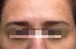 After Image: Botox - front