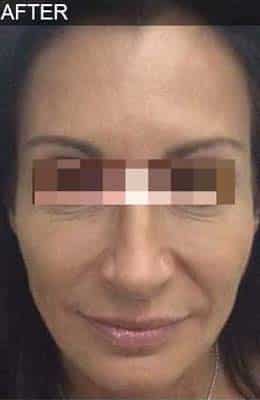 After Image: Liquid Facelift - front