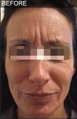 Before Image: Liquid Facelift - front